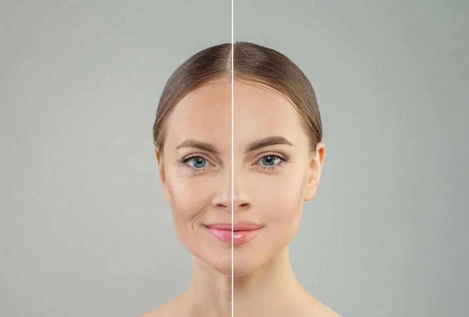 Ultherapy Skin Tightening Treatment in New York, NY by Reforma